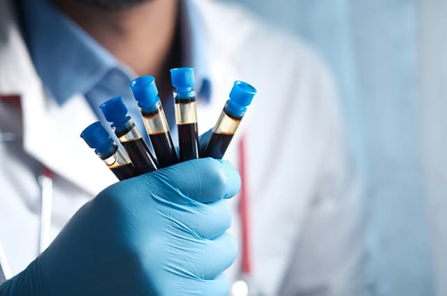 Clinician holding tubes of platelet-rich fibrin